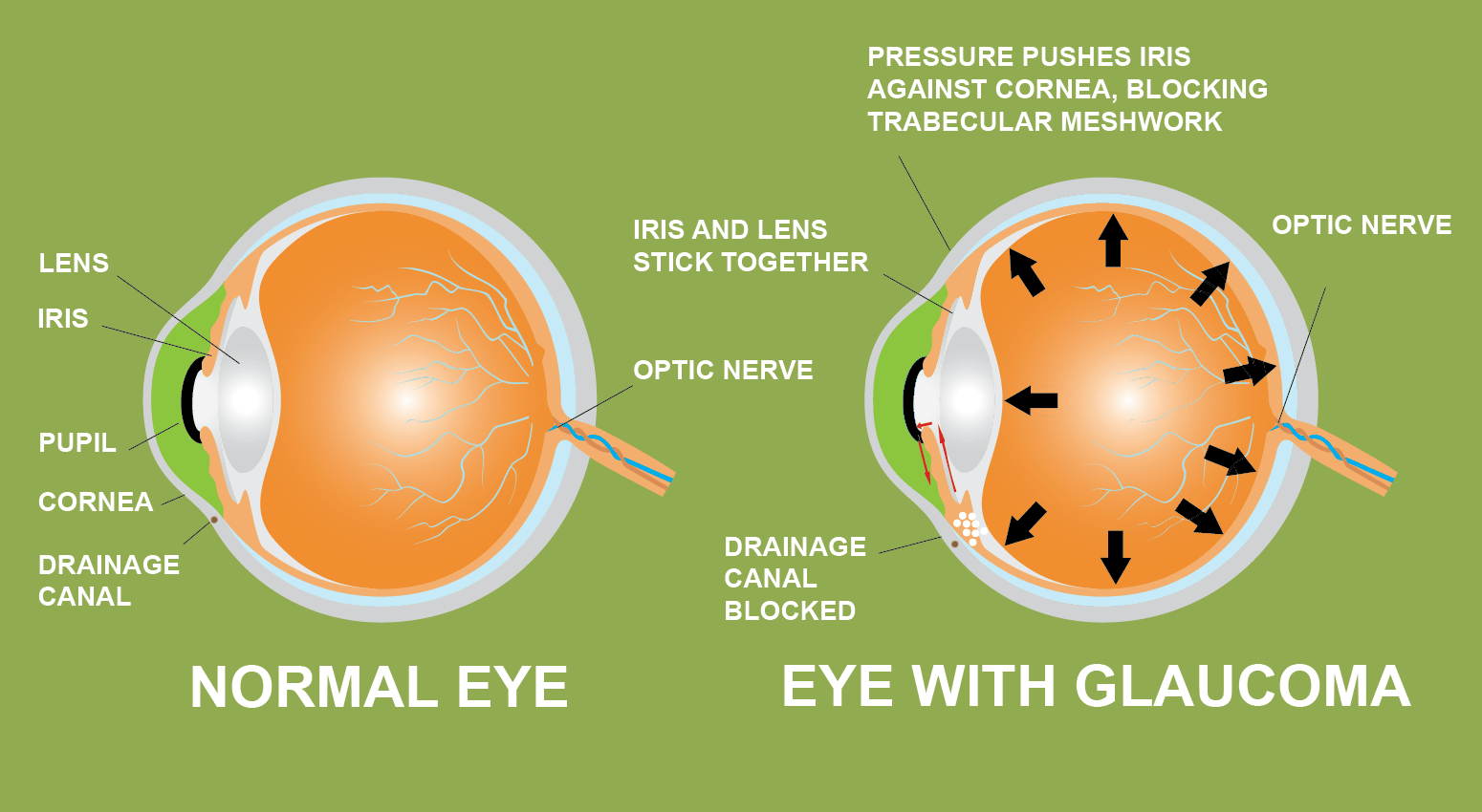 glaucoom iris lens pupil hoornvlies afwateringskanaal cannabis voorkomen