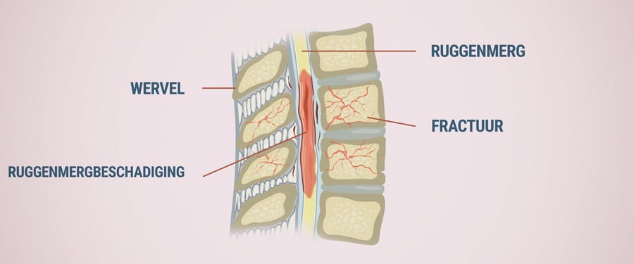 Schade Aan Het Ruggenmerg