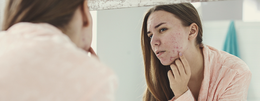 Hoe ontstaat acne? Hoe ontstaat acne?