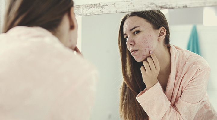 Hoe ontstaat acne? Hoe ontstaat acne?