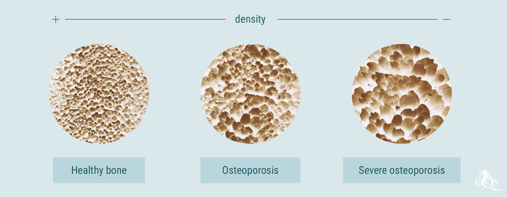 Wiet en osteoporose