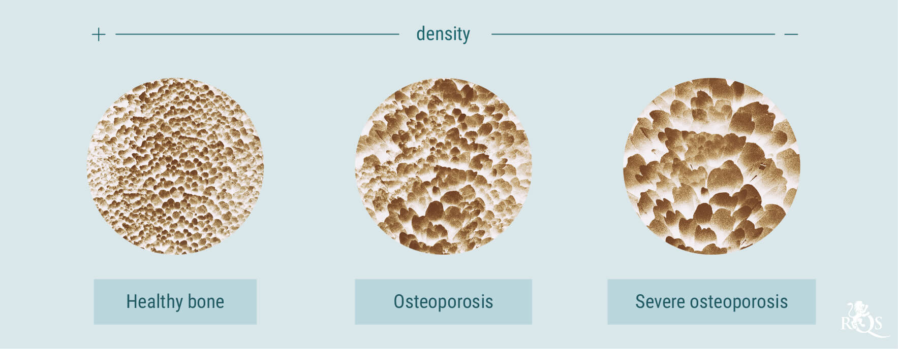 Wiet en osteoporose Wiet en osteoporose