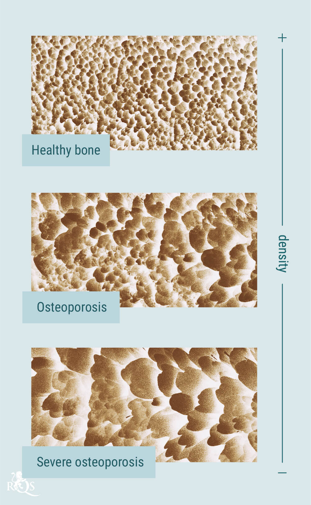 Wiet en osteoporose