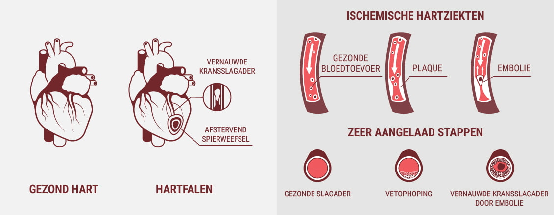 Zijn hart- en vaatziekten en hartziekten hetzelfde?