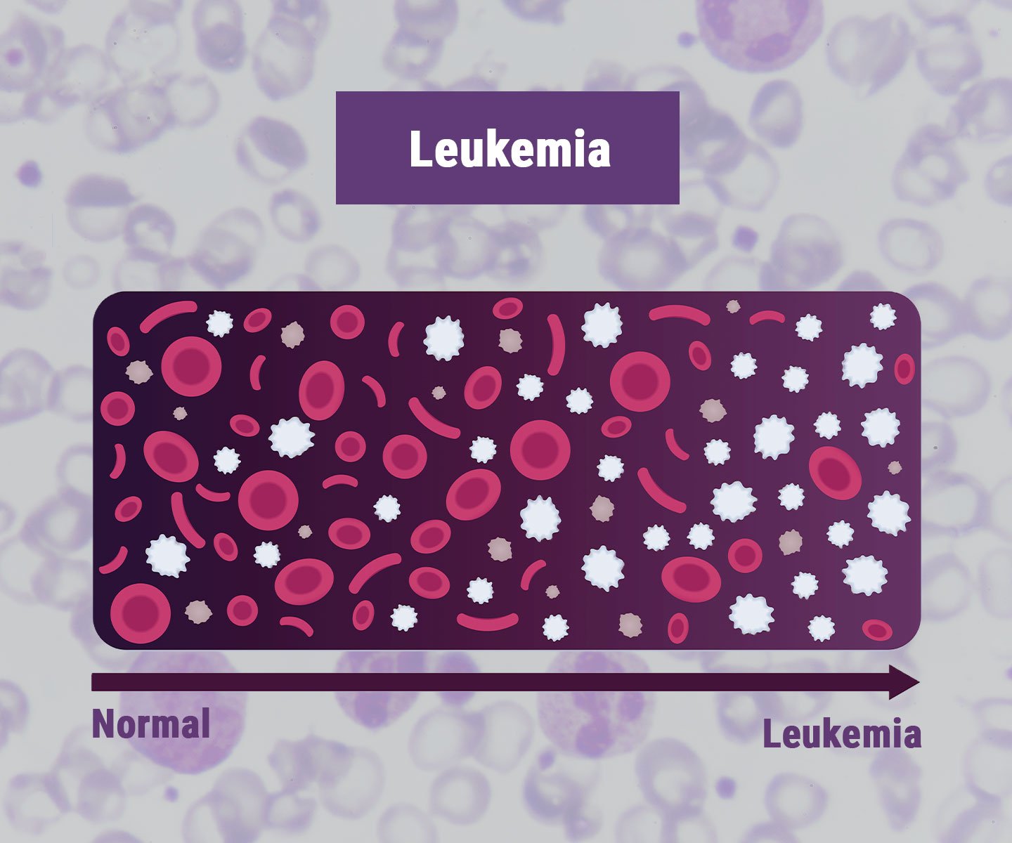 Leukemie