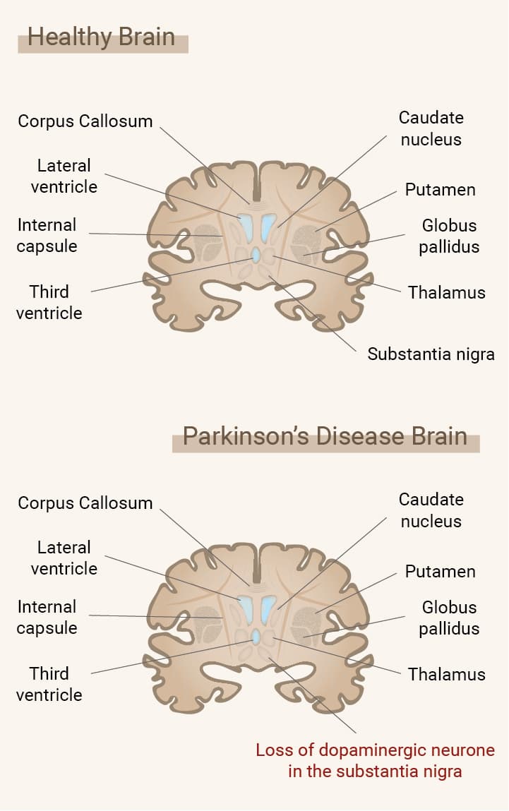Wat is de ziekte van Parkinson?