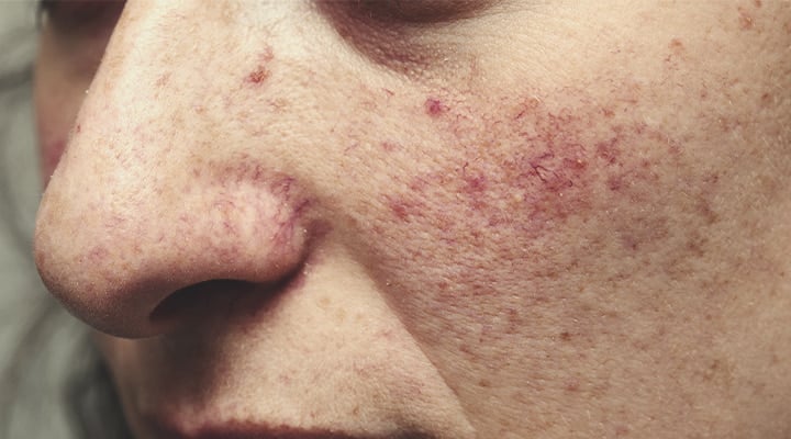 Hoe ontstaat rosacea?