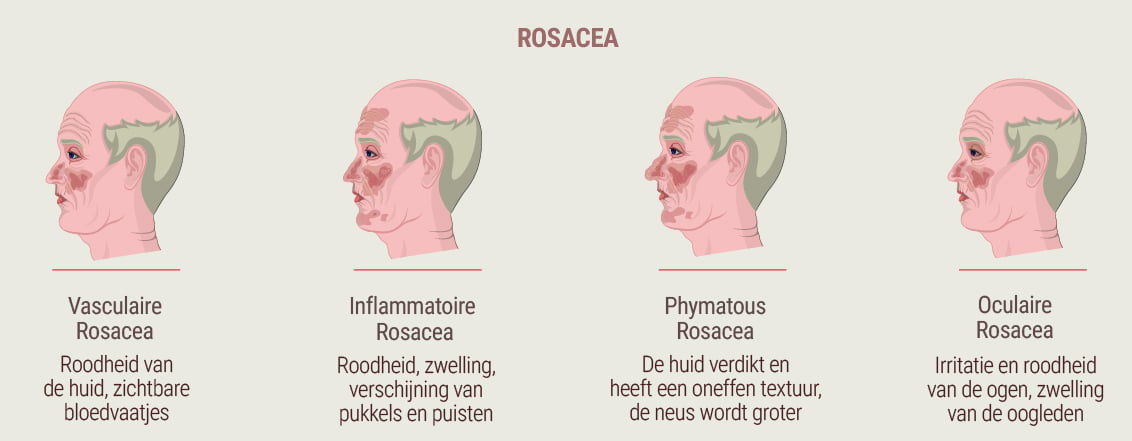 Wat is rosacea?