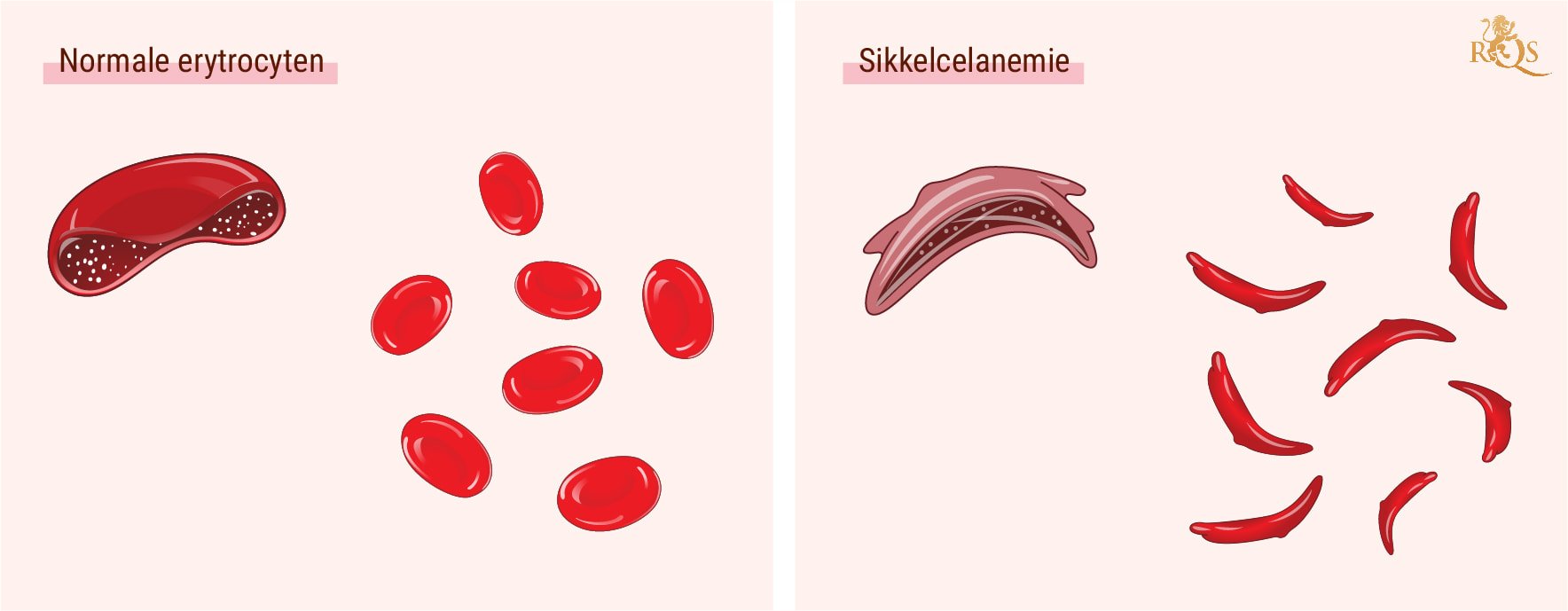 Wat is sikkelcelanemie? Wat is sikkelcelanemie?