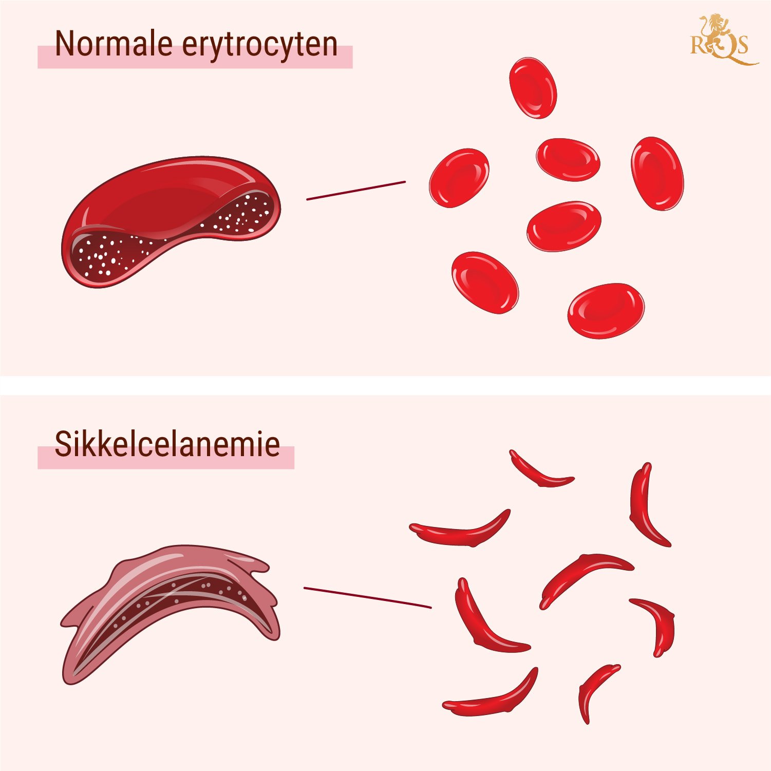 Wat is sikkelcelanemie? Wat is sikkelcelanemie?