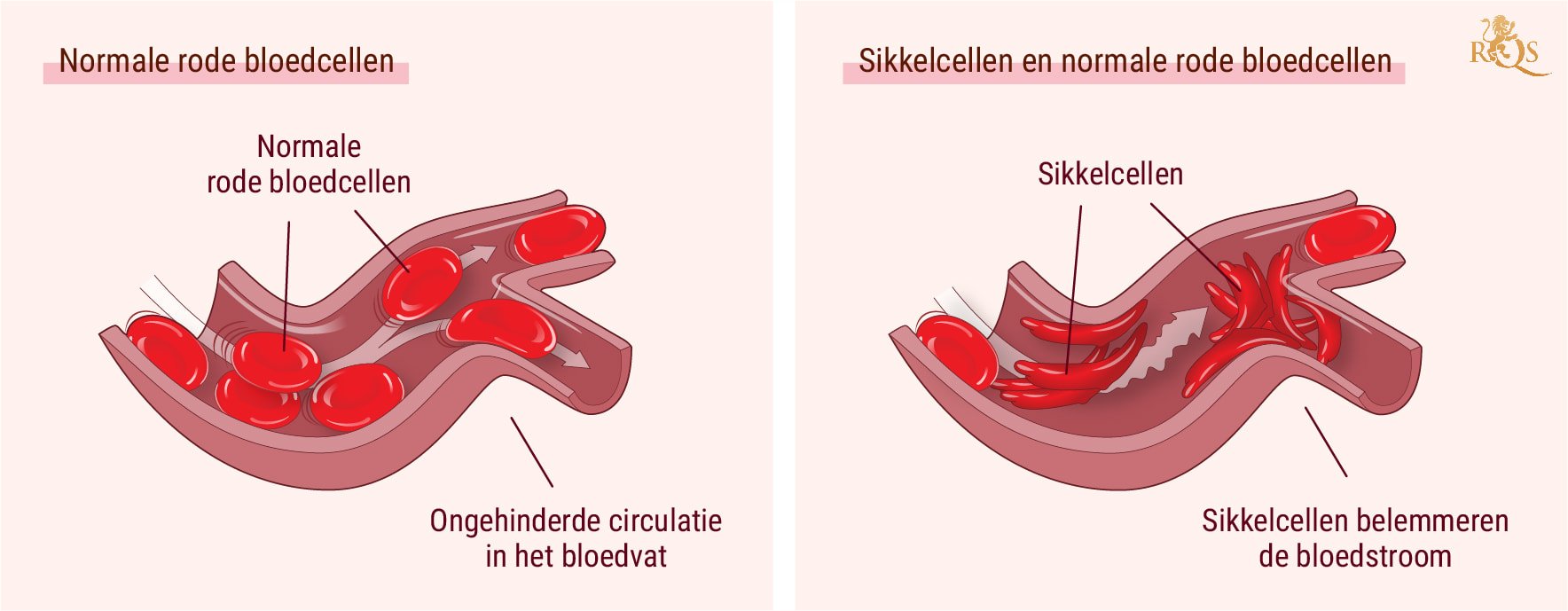 Cannabis en de klachten van sikkelcelanemie