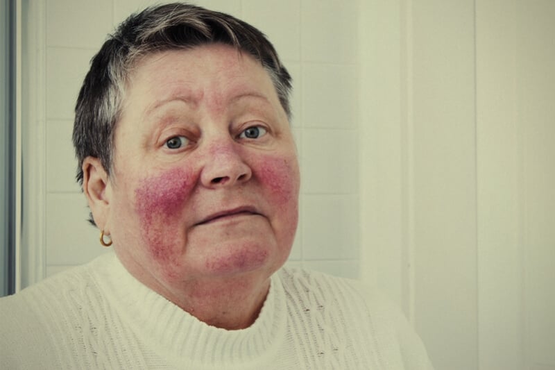 In hoeverre verminderen wiet en CBD de symptomen van rosacea?